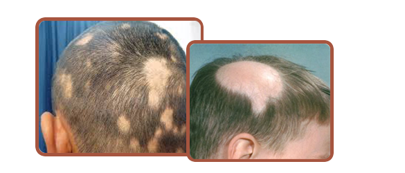 Alopecia Areata: What Is Is? | Hair Loss | Holland & Barrett