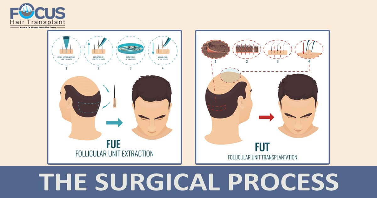 The surgical process