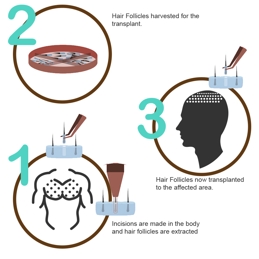 Body Hair Transplant in India, Punjab, Jalandhar | BHT Cost & Procedure