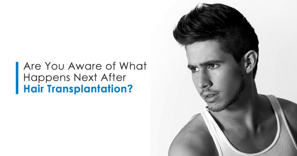 Are You Aware of What Happens Next After Hair Transplantation?