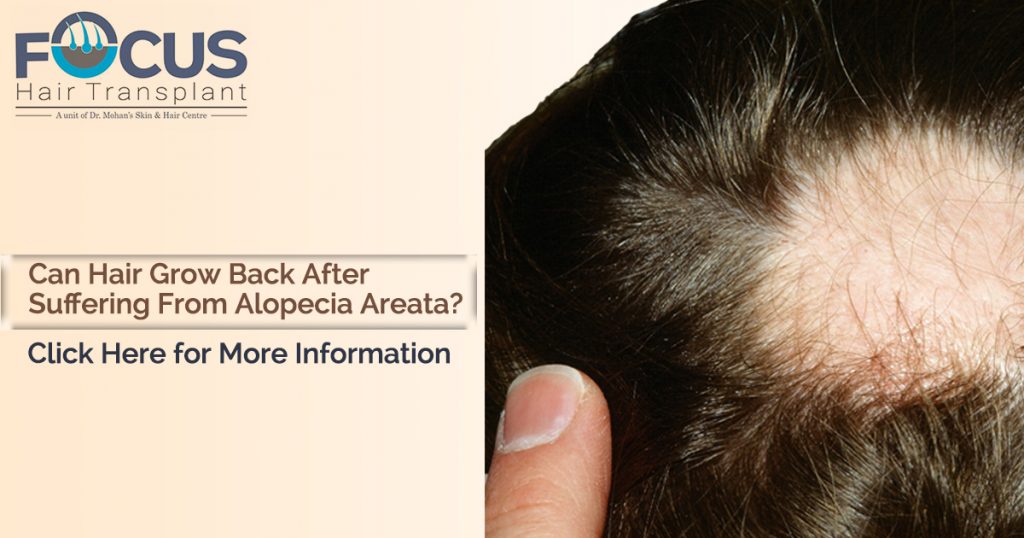 Can hair grow back after suffering from Alopecia Areata?