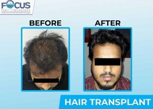 Hair Transplant in Punjab, India - Hair Transplant Centre in Jalandhar