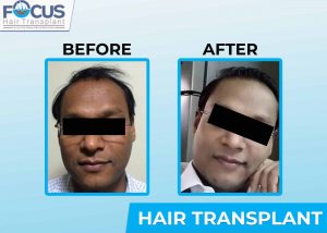 Hair transplant Results Hair Transplant Before and After  DHI