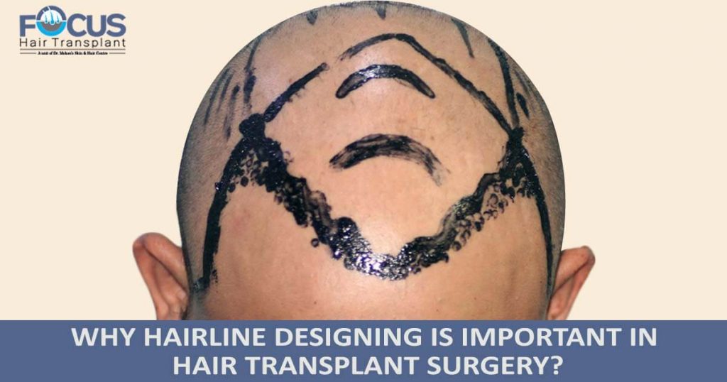 Why hairline designing is important in hair transplant surgery?