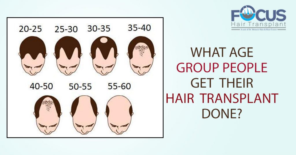 What Age Group People Get Their Hair Transplant Done?
