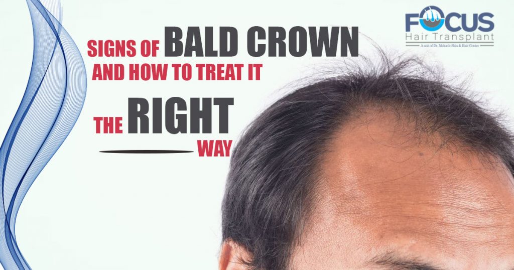 Signs of bald Crown And How to Treat it the right way