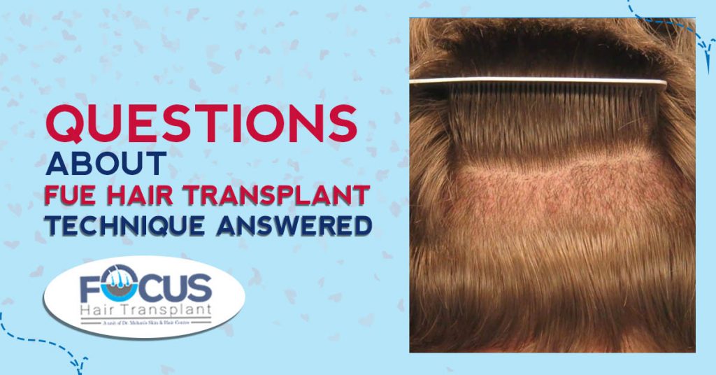 Questions About FUE hair Transplant Technique Answered