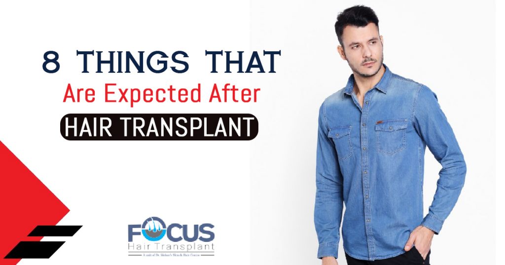 8 Things That Are Expected After Hair Transplant