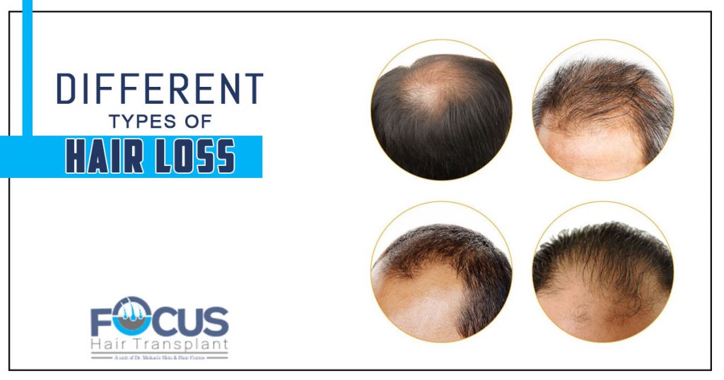 Different Types of hair loss